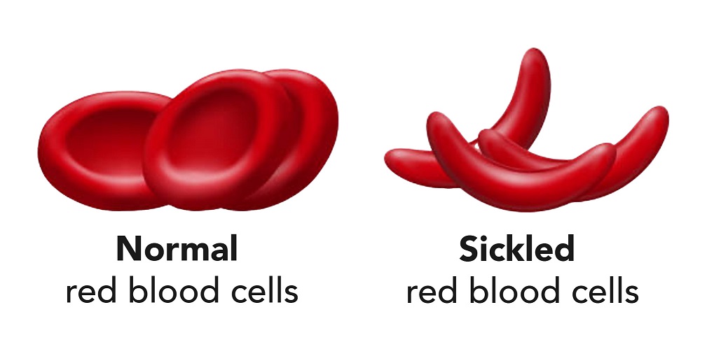 STArT Study: Arginine and sickle cell crisis